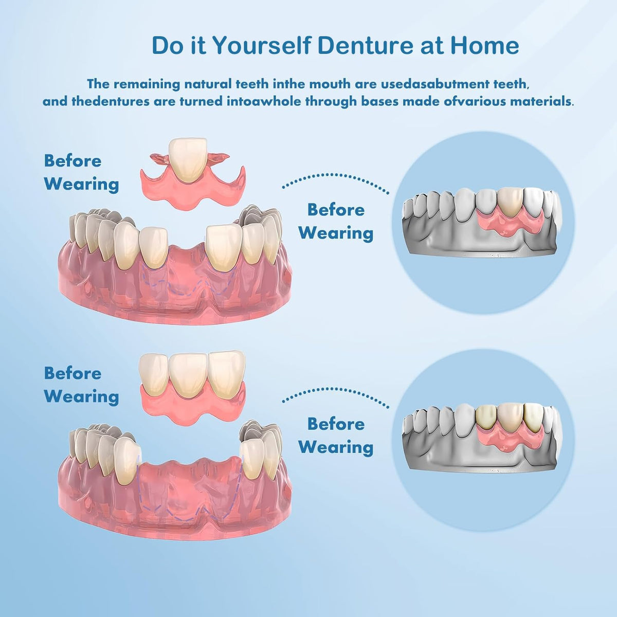 DIY Denture Complete Kit with Impression Material, Gum Material, Components for Top and Bottom Full or Partial Dentures D27692
